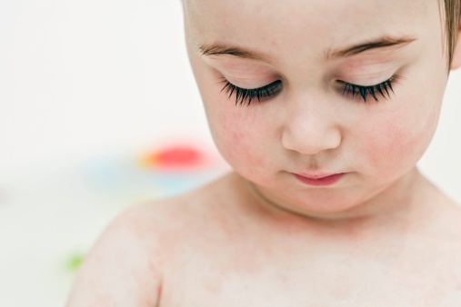 宝宝脸上反复起湿疹怎么办？